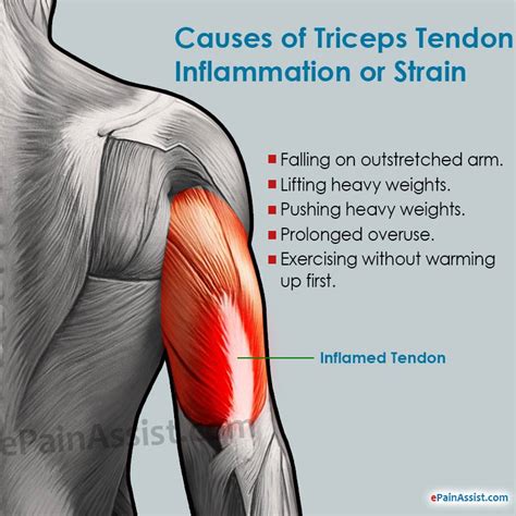 arm esk tebov|Biceps/Triceps tendon injuries